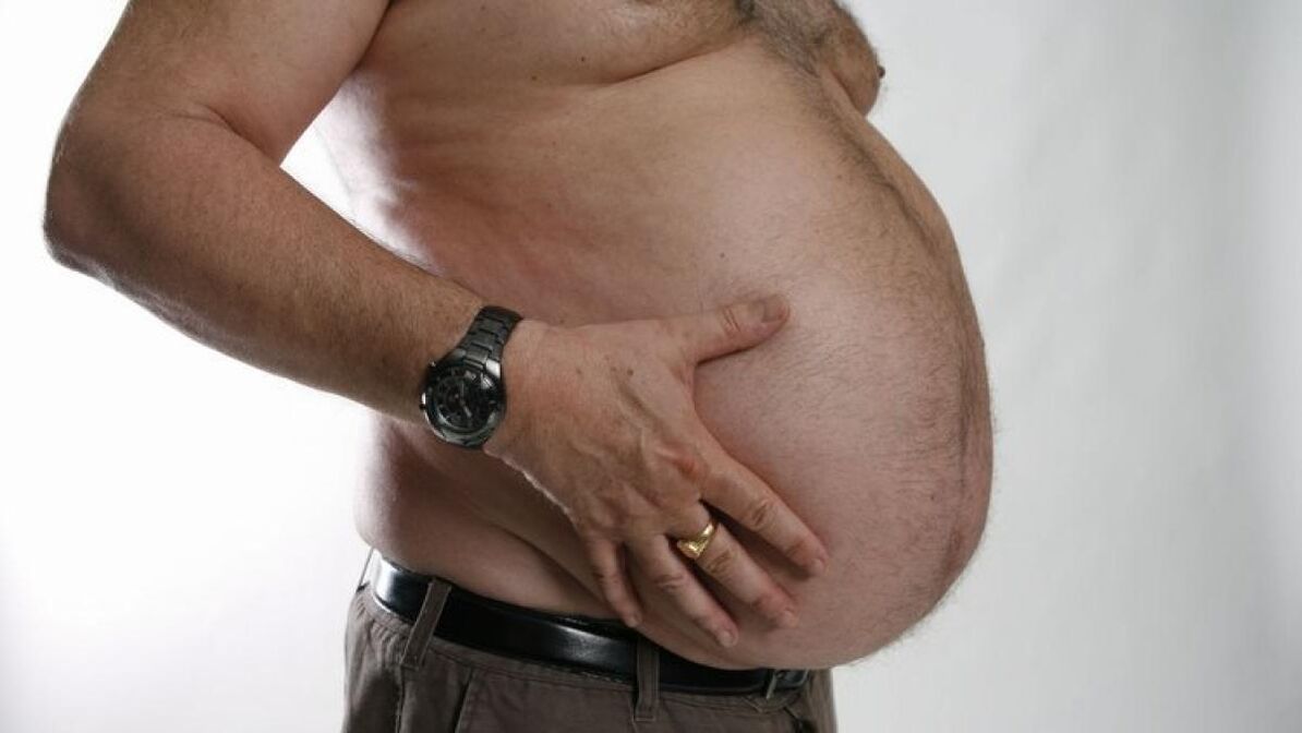 obezitatea ca o cauză a dezvoltării venelor varicoase