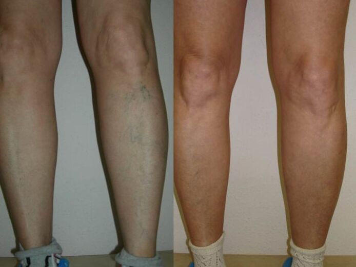 picioare înainte și după tratamentul cu laser al venelor varicoase