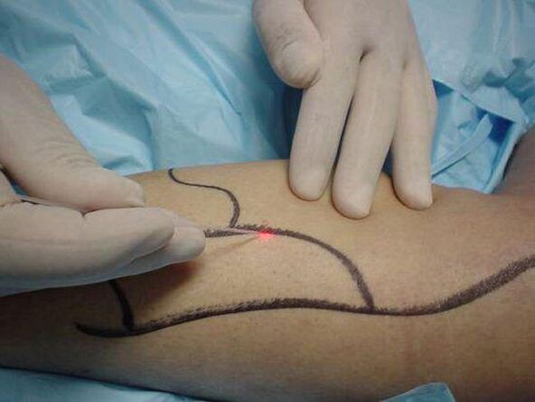 tratamentul cu laser al venelor varicoase