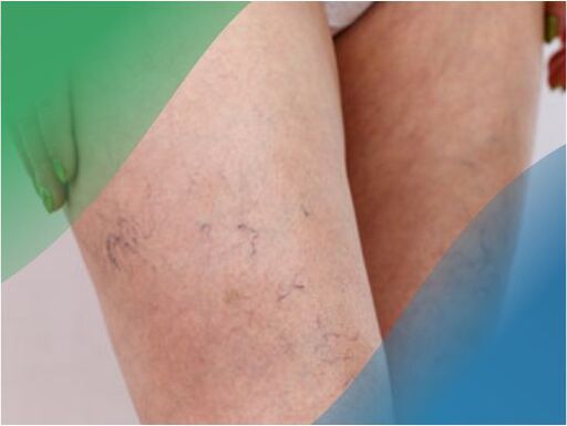 Rețeaua vasculară de pe picioare este unul dintre simptomele varicelor
