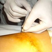 Miniflebectomia este cel mai cosmetic tratament pentru vene varicoase