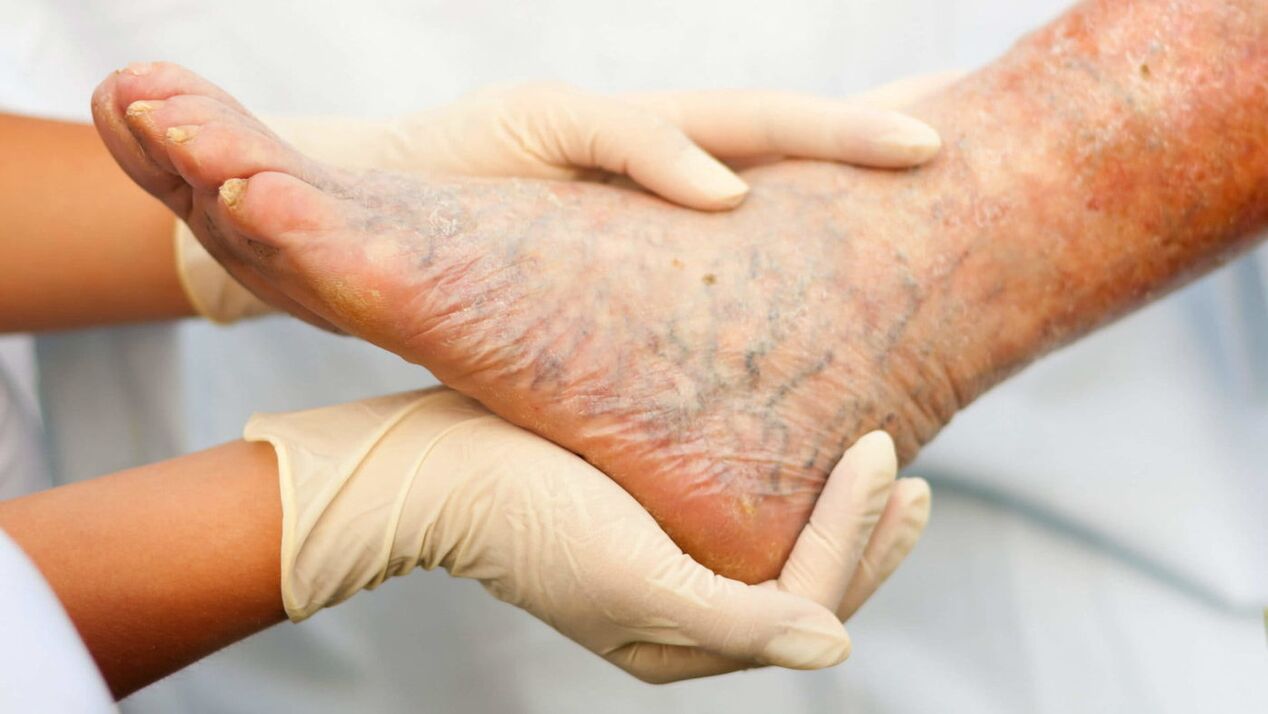 Flebologul se ocupa de tratamentul varicelor de la nivelul picioarelor