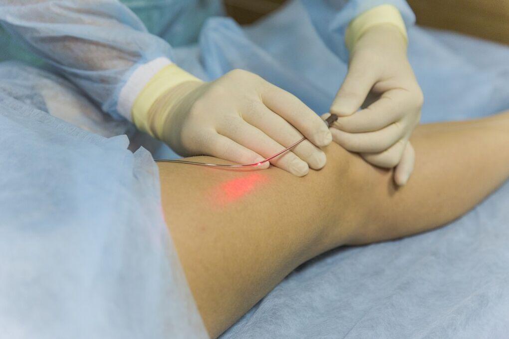 Tratamentul cu laser al venelor varicoase ale extremităților inferioare