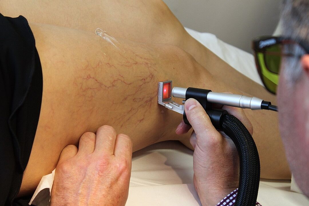 Coagulare laser