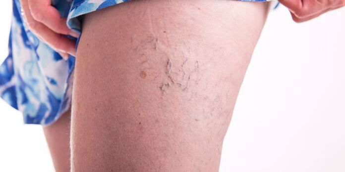 Prevenirea varicelor