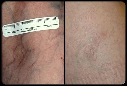 Înainte și după procedura de terapie cu laser